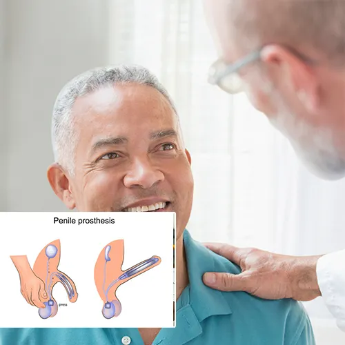 Welcome to  Wauwatosa Surgery Center 
: Your Trustworthy Partner in Penile Implant Solutions